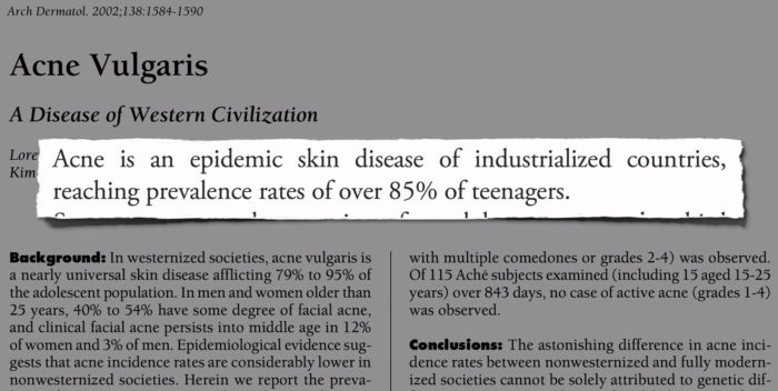 Az akne egy fertőző bőrbetegség ami a tinédzserek 85 százalékánál megfigyelhető