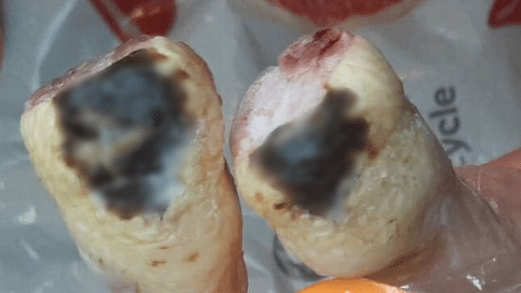 Égési sérülések jelentek meg a bolti csirkehúsokon